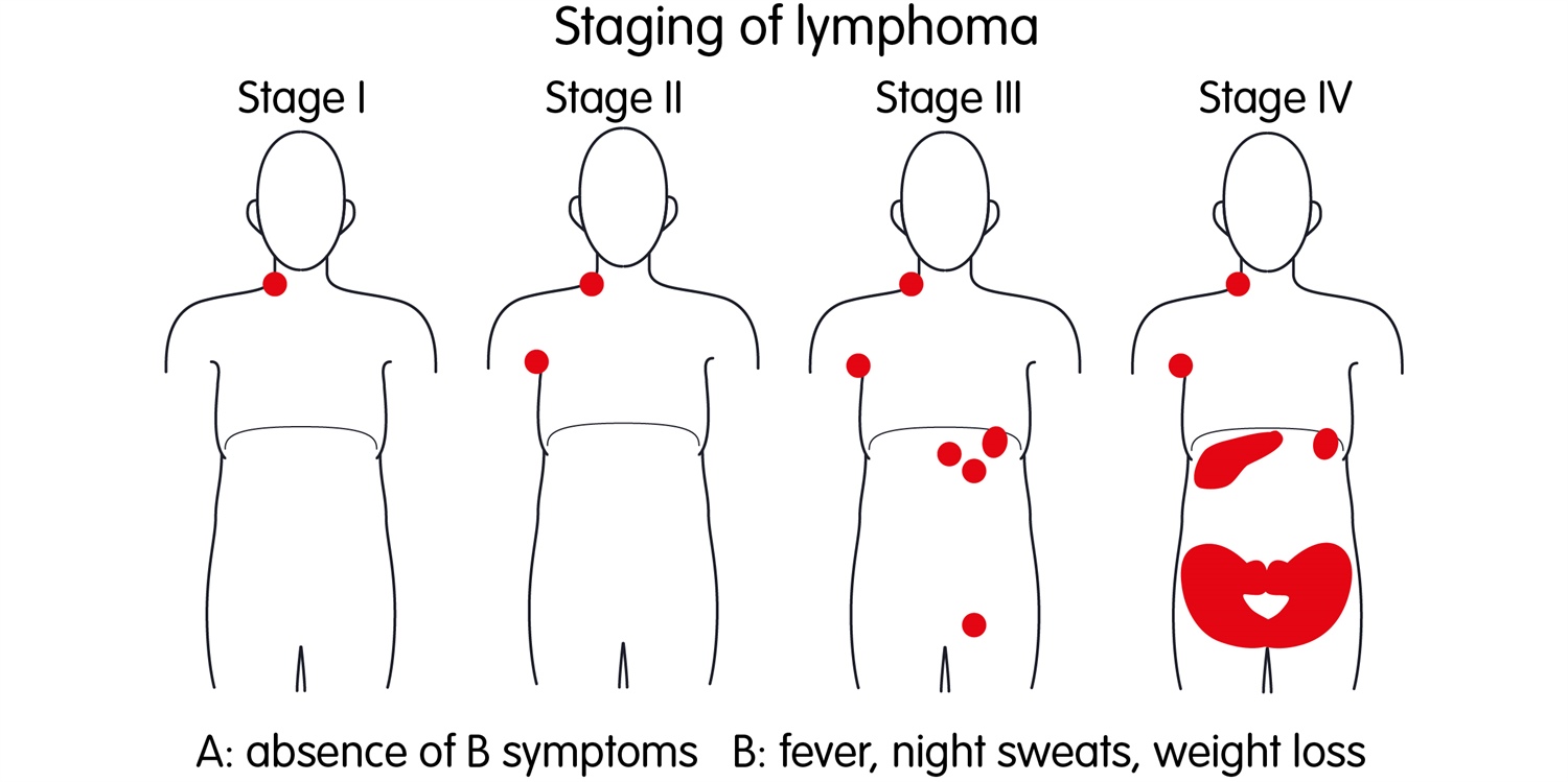 Childhood Hodgkin Lymphoma Disease Stages And Prognosis